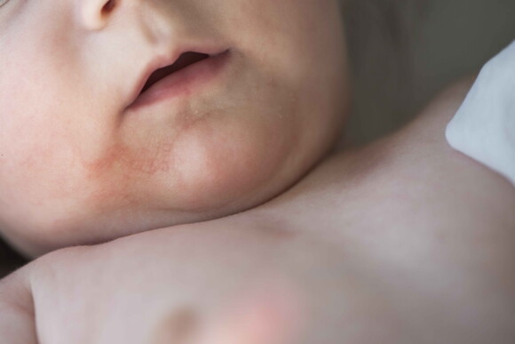A child with eczema, one of the symptoms of baby allergies. 